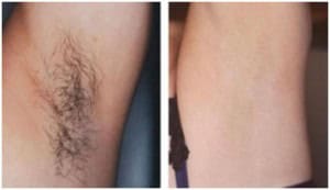 Laser-Hair-Removal_1