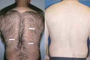 back hair removal fwac